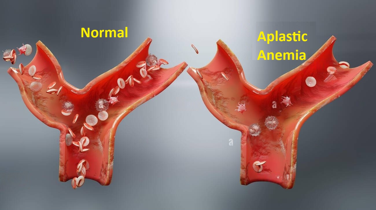 Aplastic Anemia